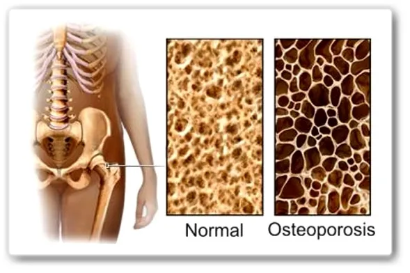 Osteoporosis