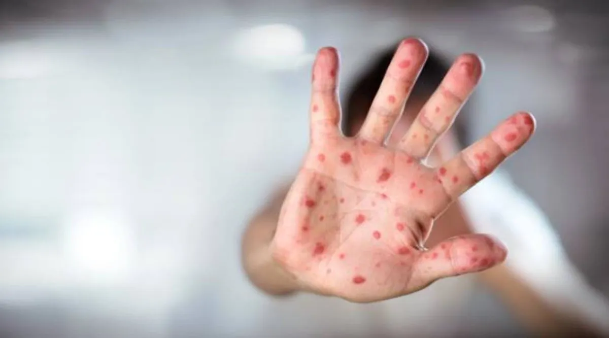 Más de 5.000 casos de sarampión en Italia por los movimientos antivacunas