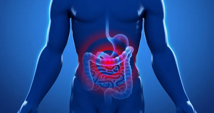 cancer de colon