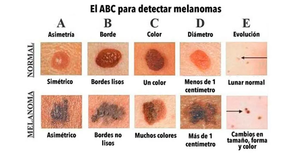 cómo saber si un lunar es malo