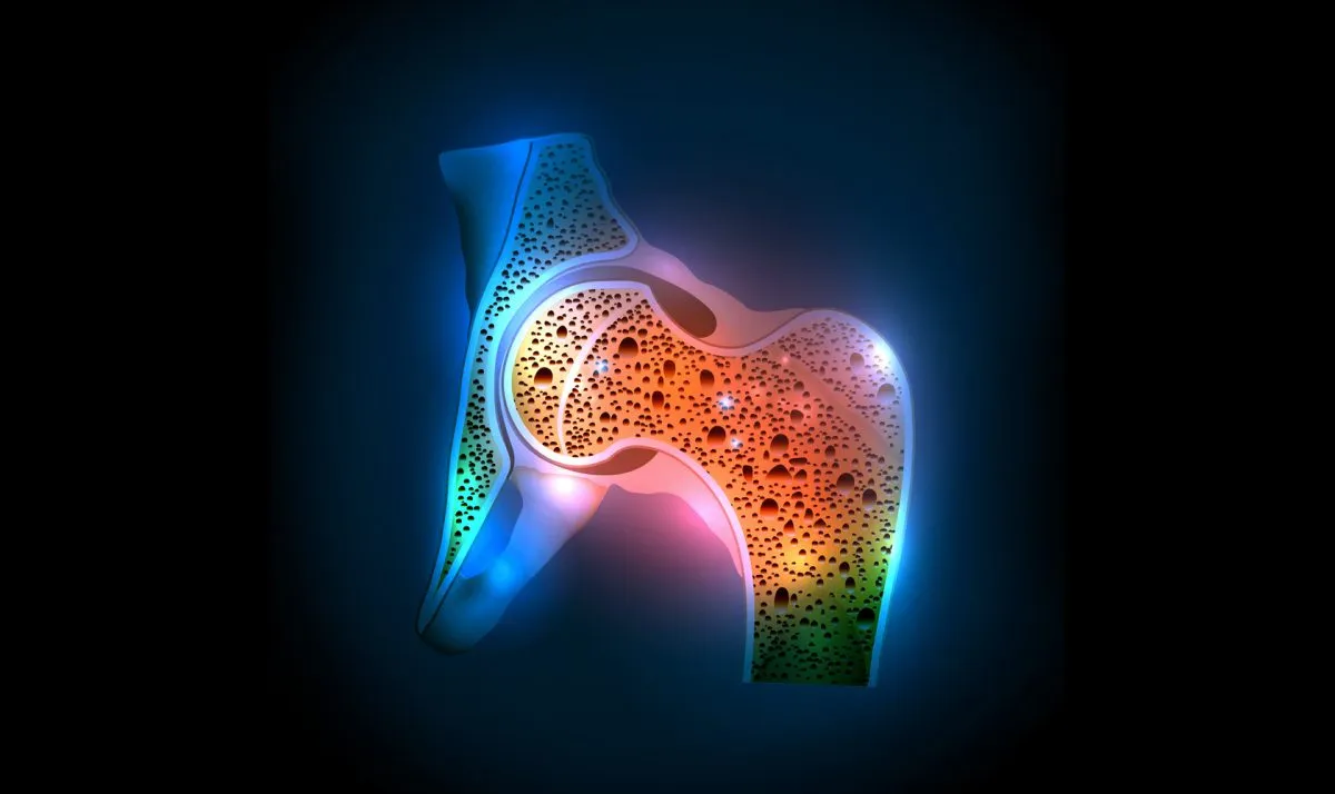 osteoporosis