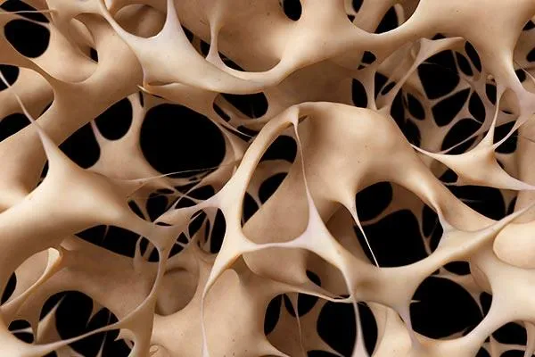 osteoporosis