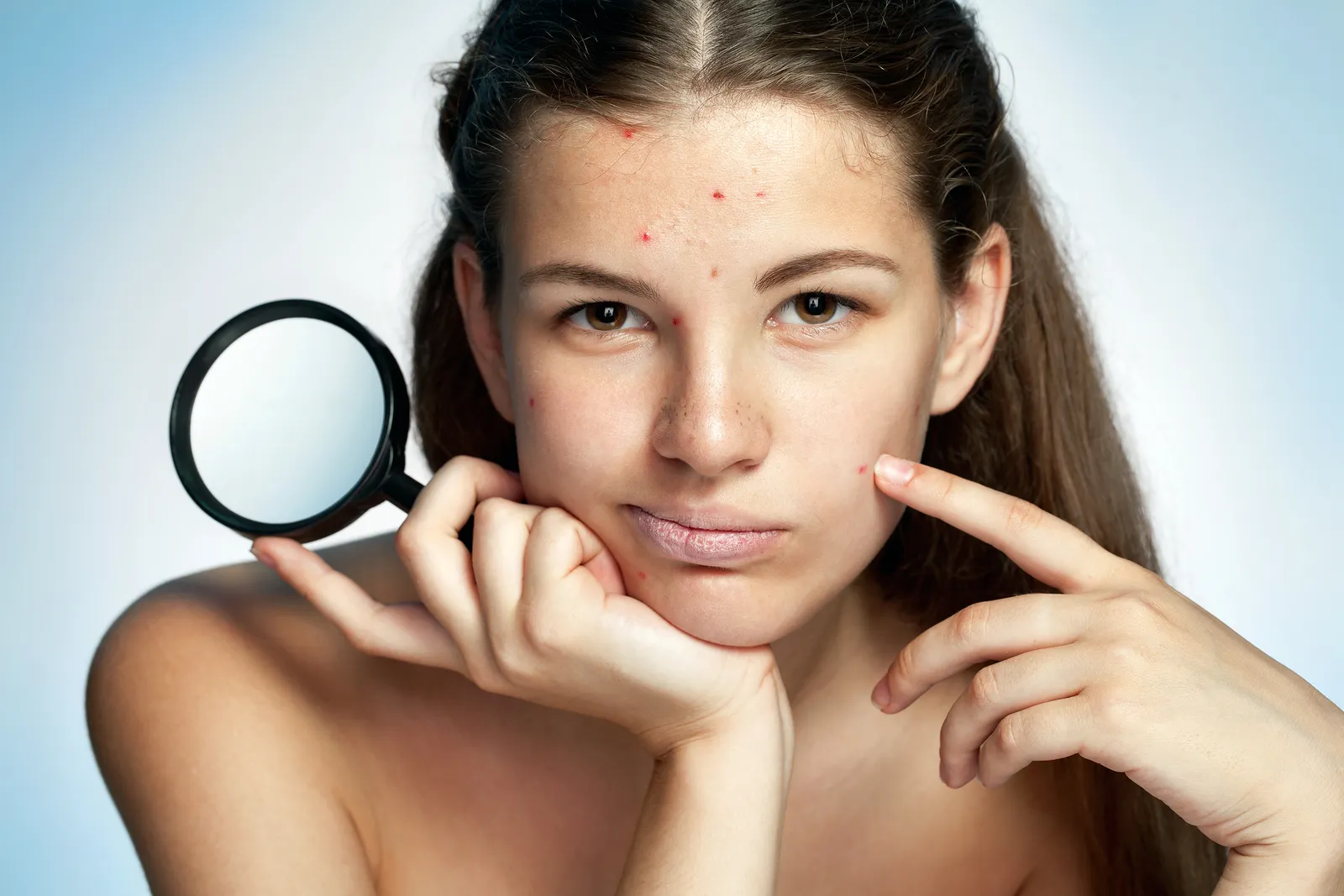 como combatir la rosacea