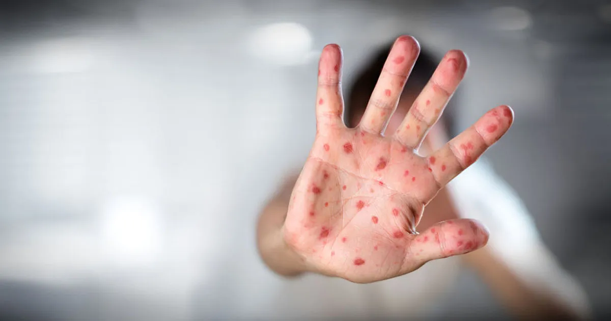 que antibiotico se toma para la culebrilla