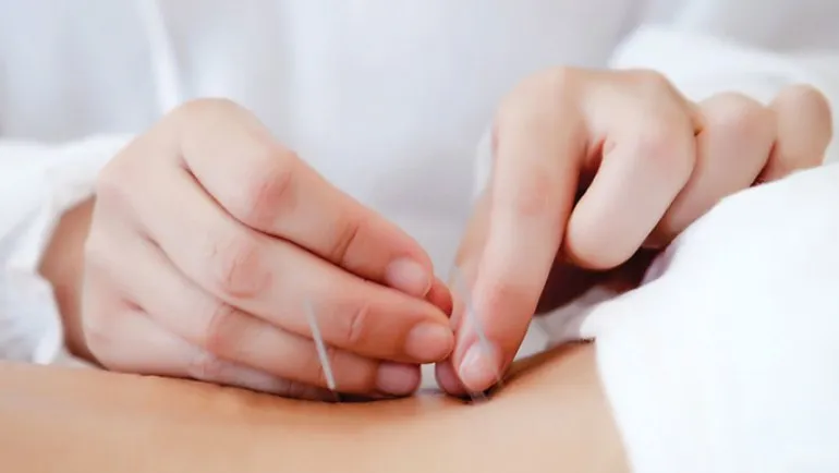 acupuntura