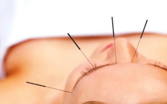 acupuntura