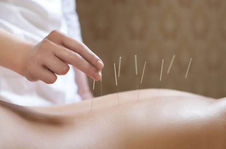 acupuntura