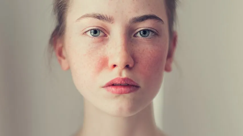 cremas para la rosacea nerviosa