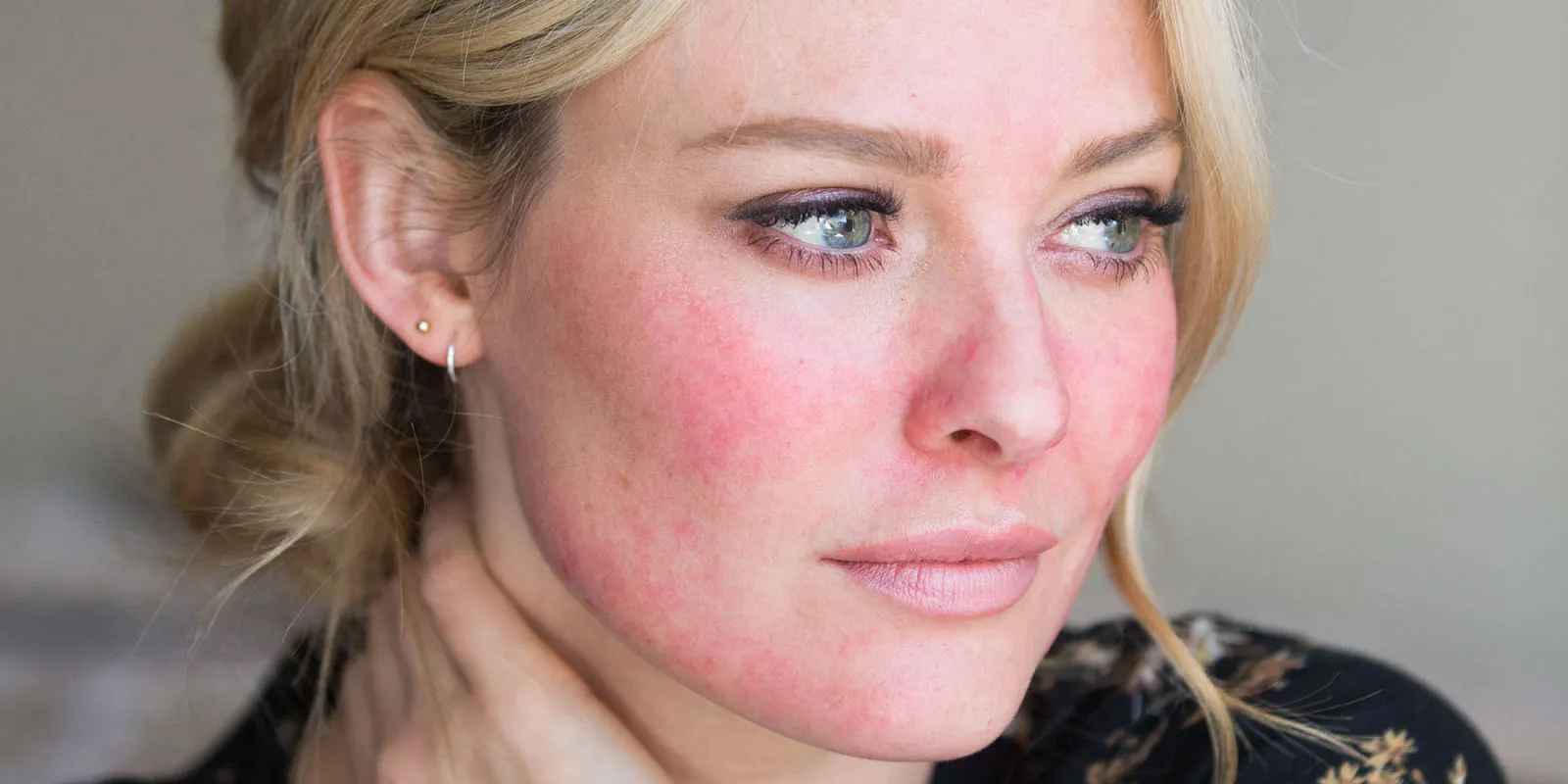 rosacea remedios caseros