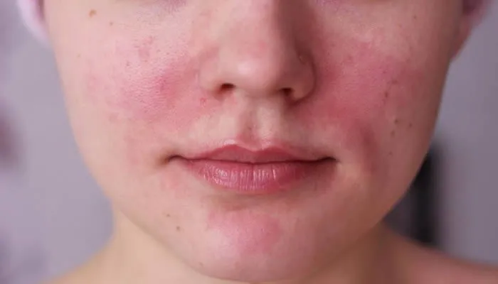 como tratar la rosacea cremas