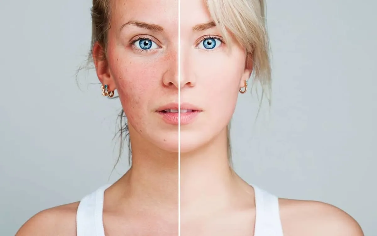 como curar la rosacea