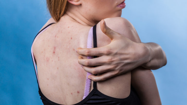 cómo curar la alergia en la piel
