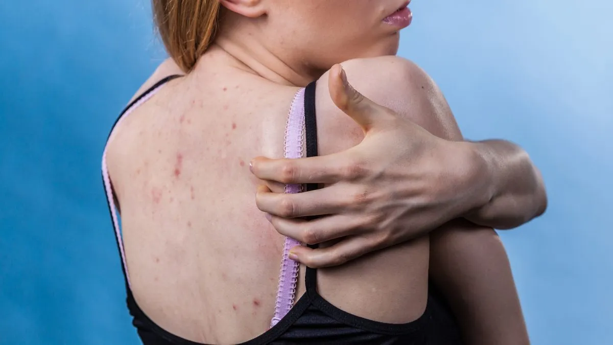 como eliminar la rosacea