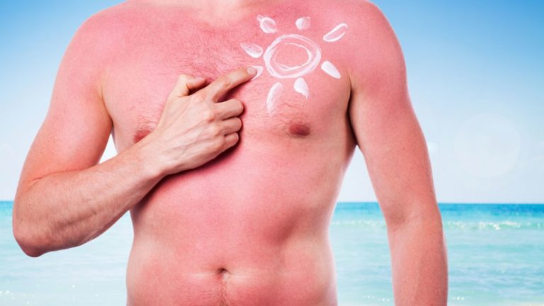 protector solar cancer de piel