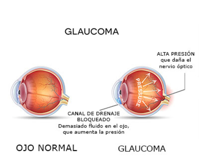 glaucoma que es