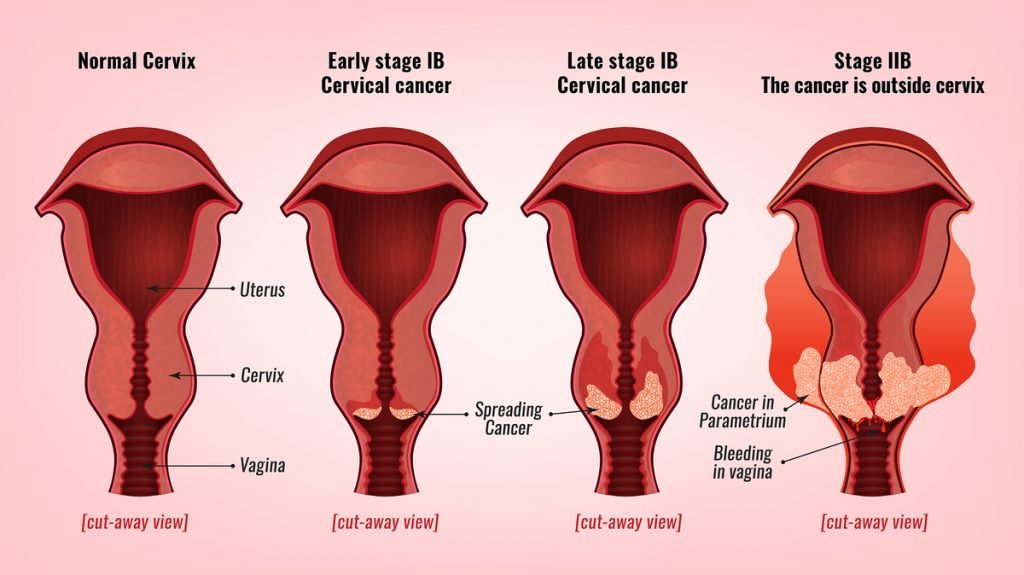 como se contagia el papiloma humano en mujeres sintomas