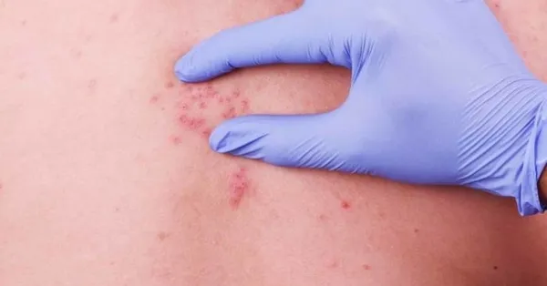 que es la culebrilla y como se contagia
