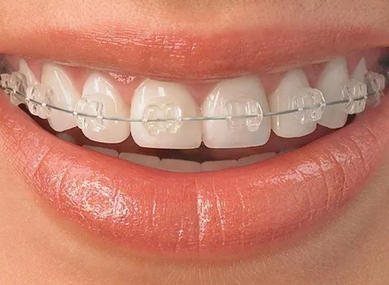 brackets