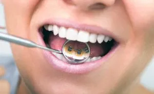 Brackets linguales