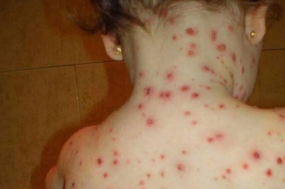 varicela antivacunas
