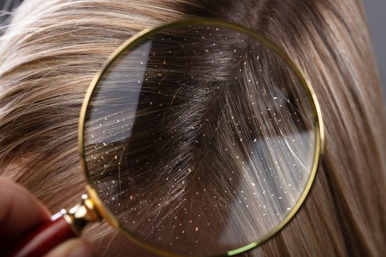 Caspa en el cabello: causas y tratamientos efectivos La caspa en las raíces del cabello tiene tratamiento.
