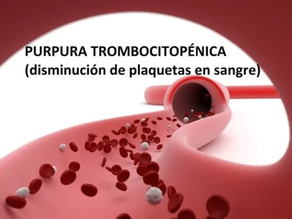 PTI enfermedad y tratamiento