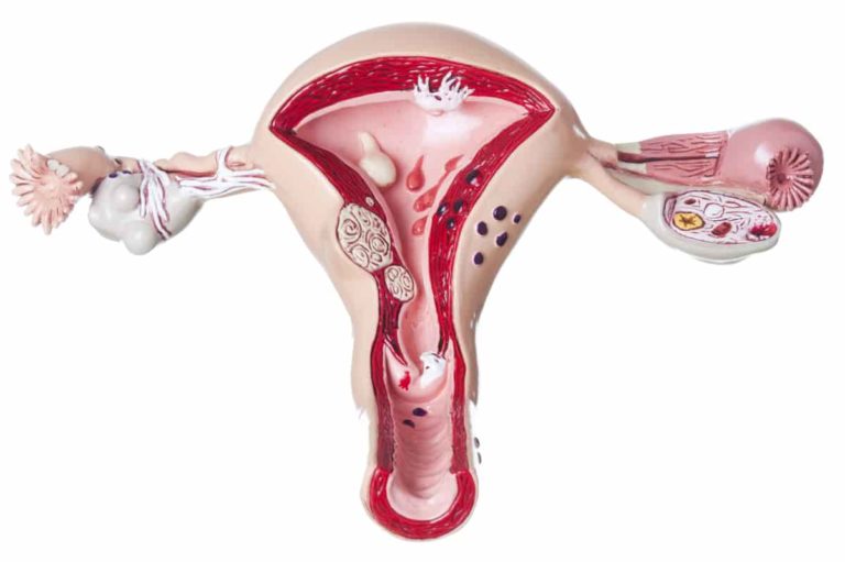 que es el ovario poliquistico