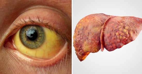 Qué es la cirrosis: síntomas, causas y tratamiento 8 que es la cirrosis
