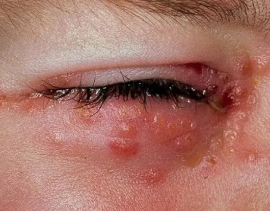 culebrilla cortar con tijera