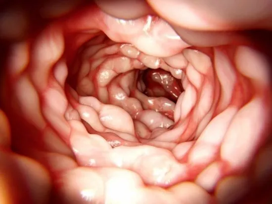 colonoscopia colonoscopia