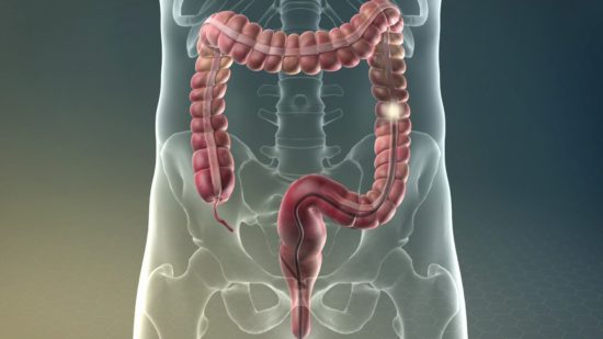 preparación para colonoscopia
