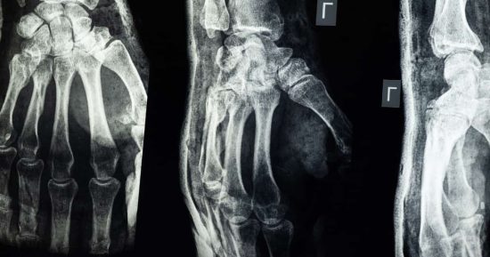 ¿Se pueden curar los huesos más rápido ante una fractura? 14 ¿Se pueden curar los huesos más rápido ante una fractura? 14