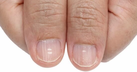 Uñas rayadas: líneas y estrías que hablan de tu salud 4