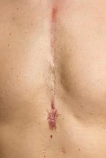 Primer plano de una cicatriz postoperatoria con adherencias en la piel, que pueden tratarse con remedios naturales.