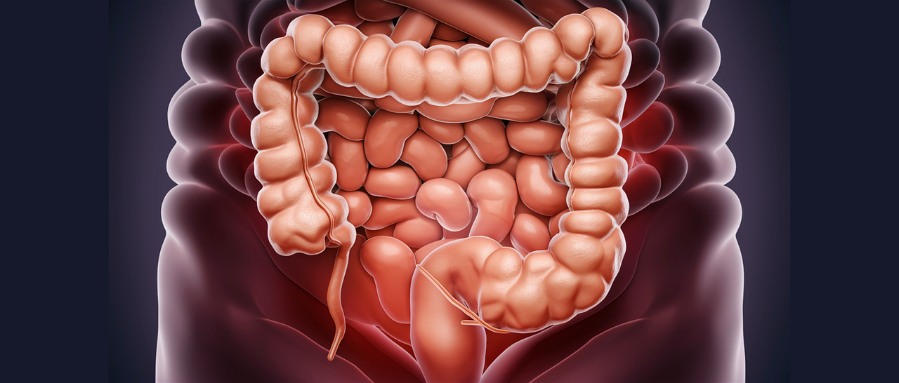 Cómo saber si el colon está limpio para una colonoscopia​