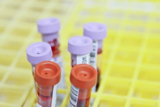 ¿Cómo se Diagnostica el Síndrome de SYNGAP1? Viales de sangre en un laboratorio listos para una prueba genética, el método clave para el diagnóstico del síndrome SYNGAP1